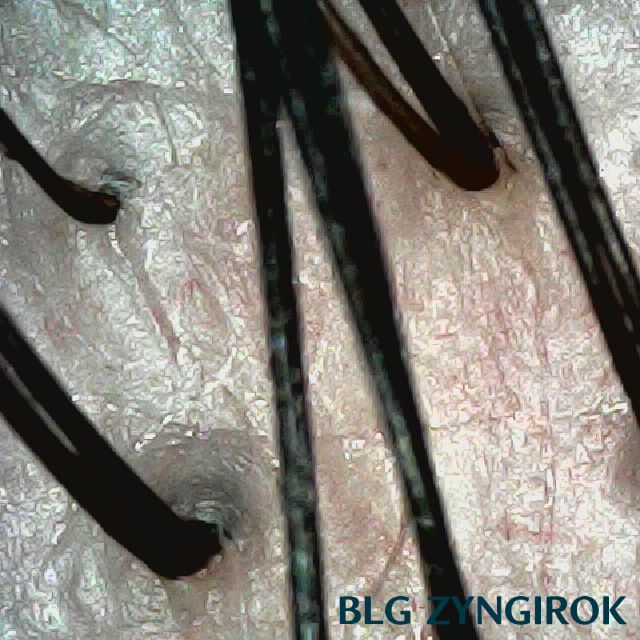 피나모아 복용 7주차 두피사진 - 뒷머리 모습이다.