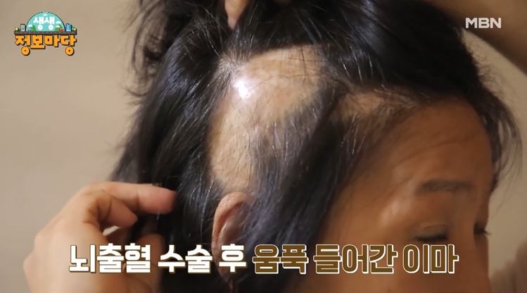 뷰티풀 맘마미아 뇌수술 후 움푹 들어간 이마 엄마 자신감 회복 주름 개선 시술 병원 신청 방법 안내
