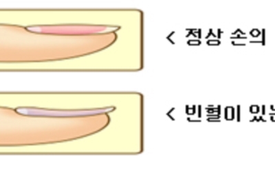 빈혈 이미지