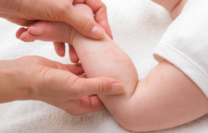 수족구 증상, 격리기간, 치료 총정리 (2024ver)