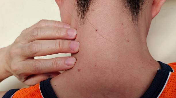 편평사마귀, 단순 제거로 끝나지 않는다? 면역치료로 근본 치료하기