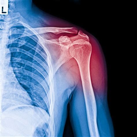 뼈골절 수술비용