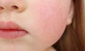 얼굴이 붉어지는 증상