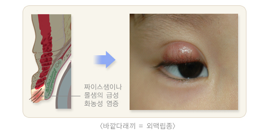 외매립종