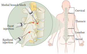 허리디스크 신경주사