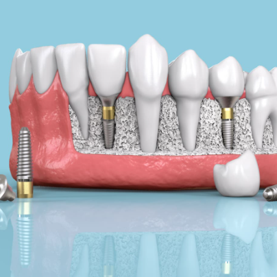 임플란트 가격 비교