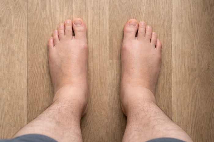 발이 붓는 이유