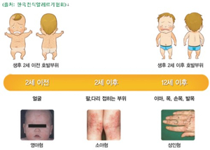 알레르기 피부염