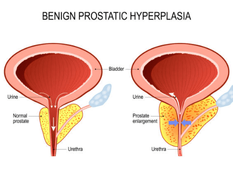 전립선 비대증 치료약