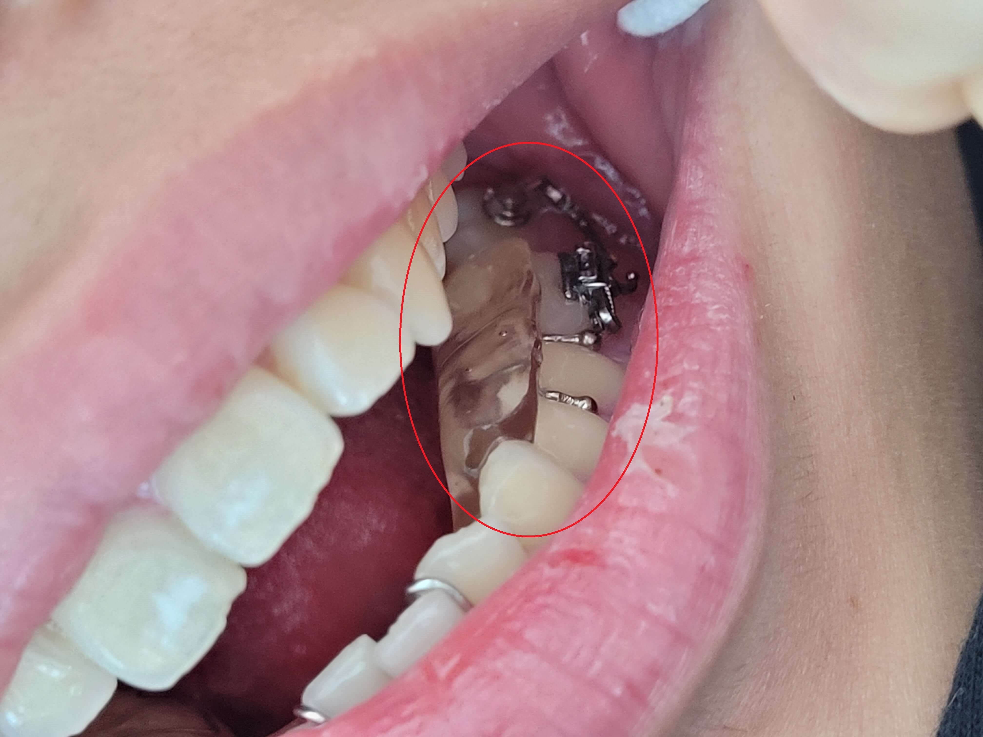 부정교합 가위교합 과개교합 치아교정 후기8