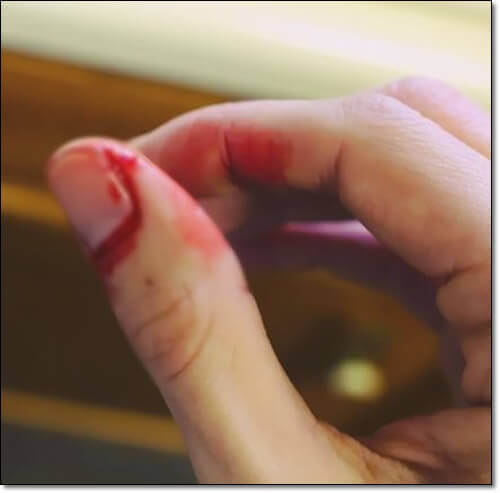 폰빌레브란트 치료