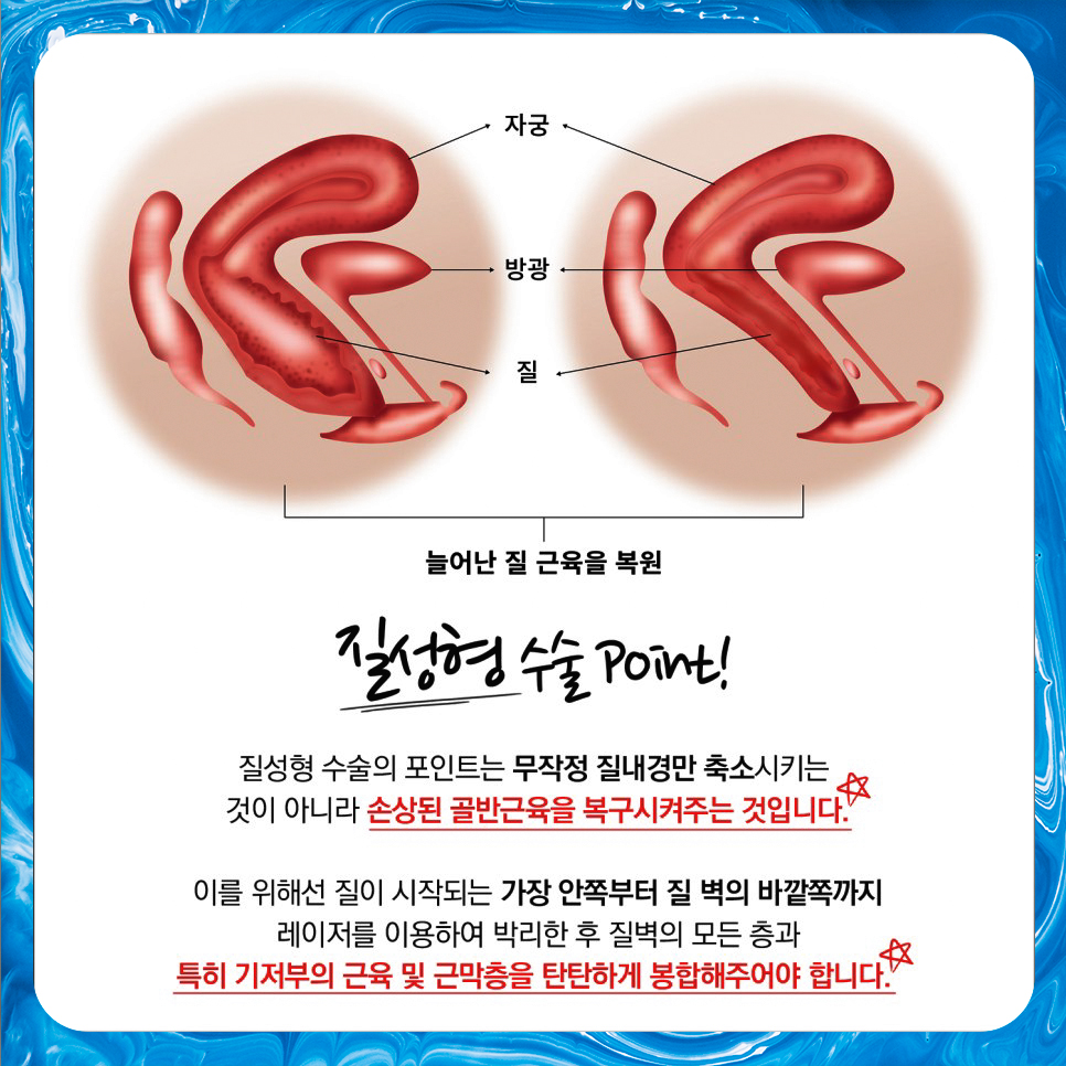 질성형수술 포인트
예쁘니수술 포인트