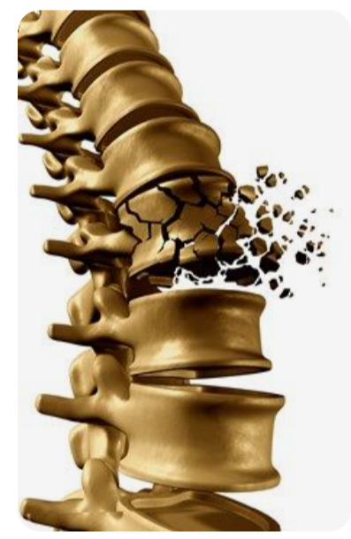 골다공증-원인-증상
