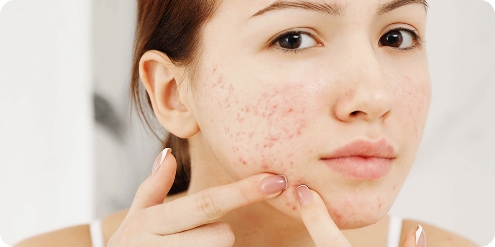 밀크시슬-효과-여드름개선