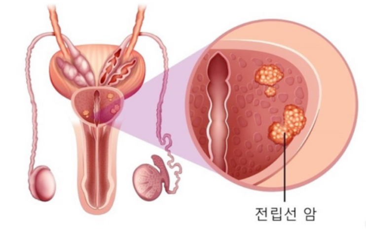 전립선 암