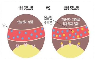 1형과-2형-당뇨병-비교