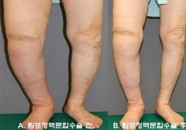림프부종