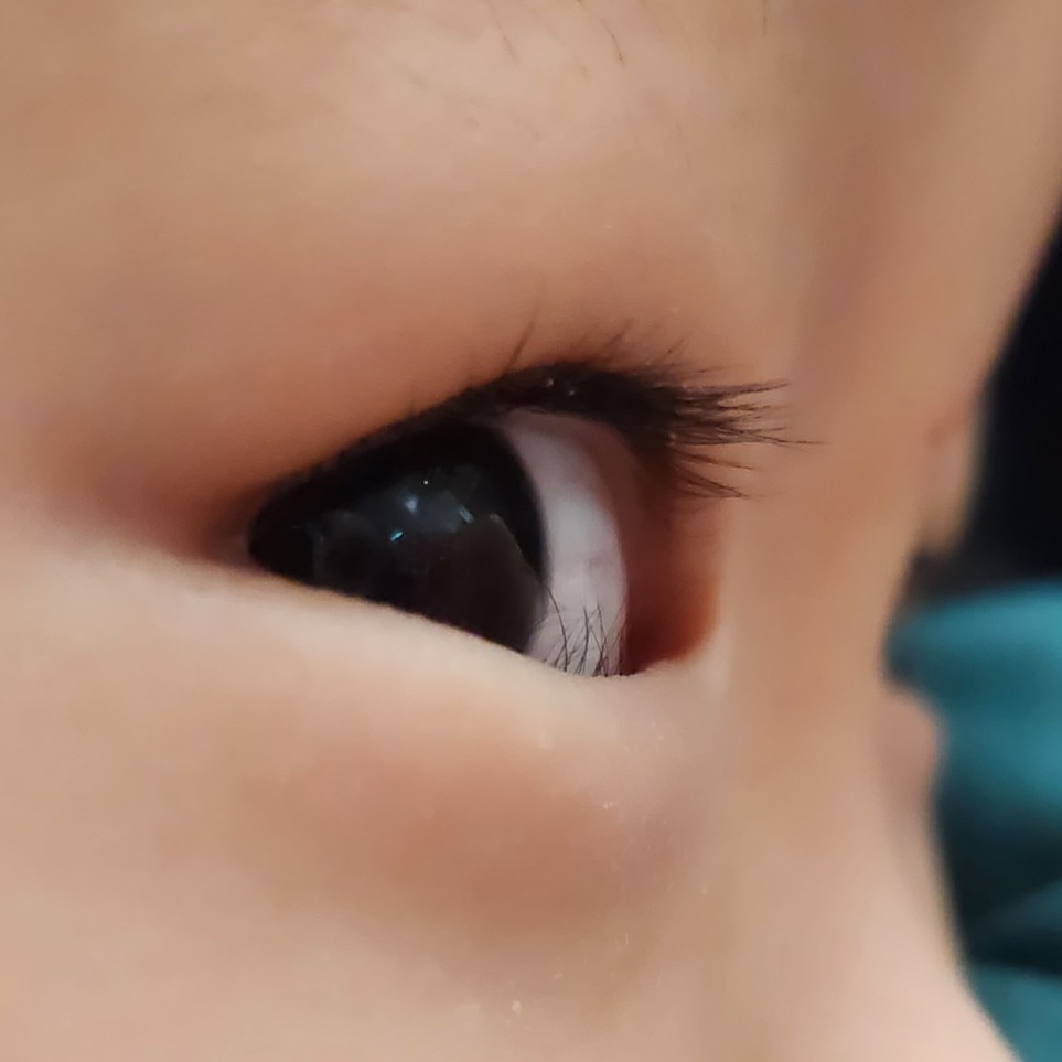 아래 속눈썹이 눈을 찌르는 모습