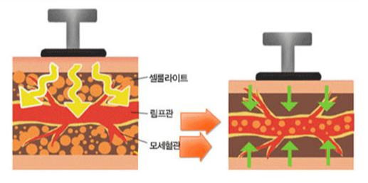 셀룰라이트