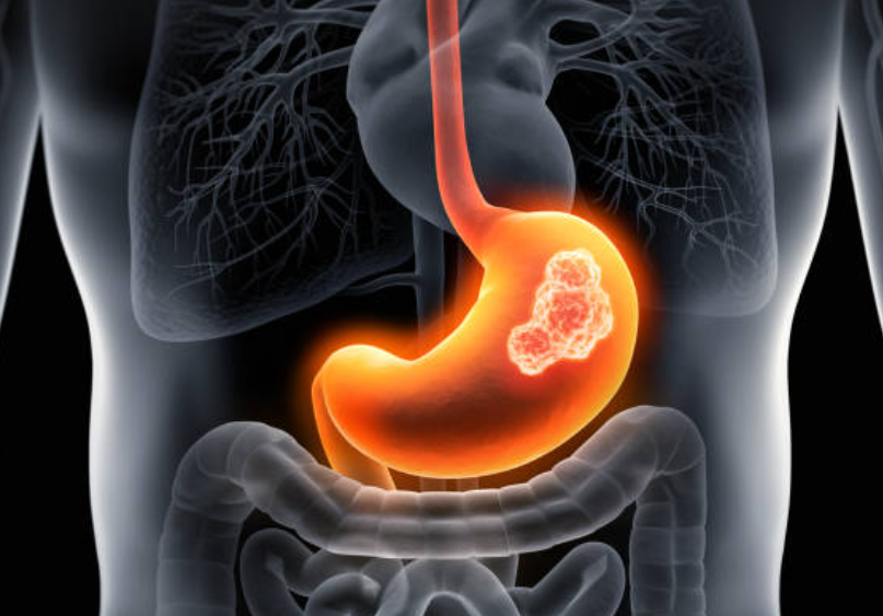 위암과 관련된 사진1