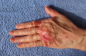 화상 물집 치료방법, 터뜨리지 말고 이렇게 치료하세요!