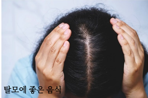 탈모에 좋은 음식 알아보기, 탈모 원인