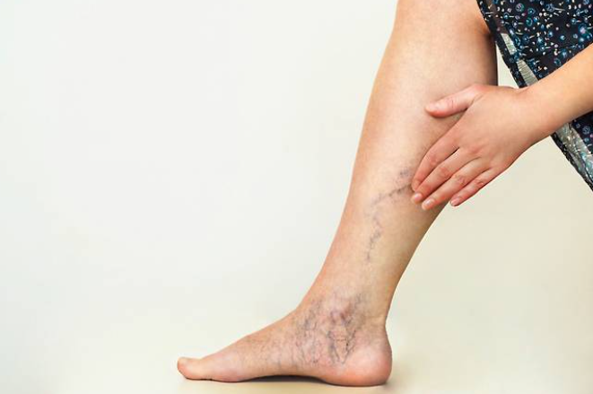 하지정맥류 원인&amp;#44; 증상&amp;#44; 치료와 예방
