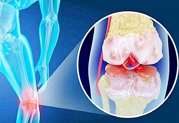 욱신거리는 무릎통증: 주요원인, 종류, 해결방법, 예방을 위한 팁.