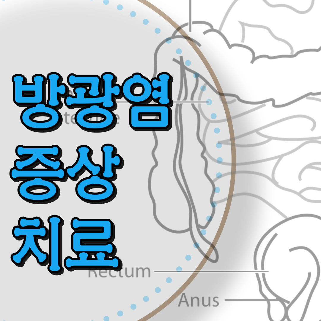 [방광염] 증상-치료-병원