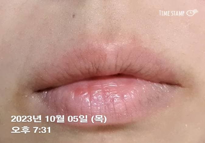 구순염