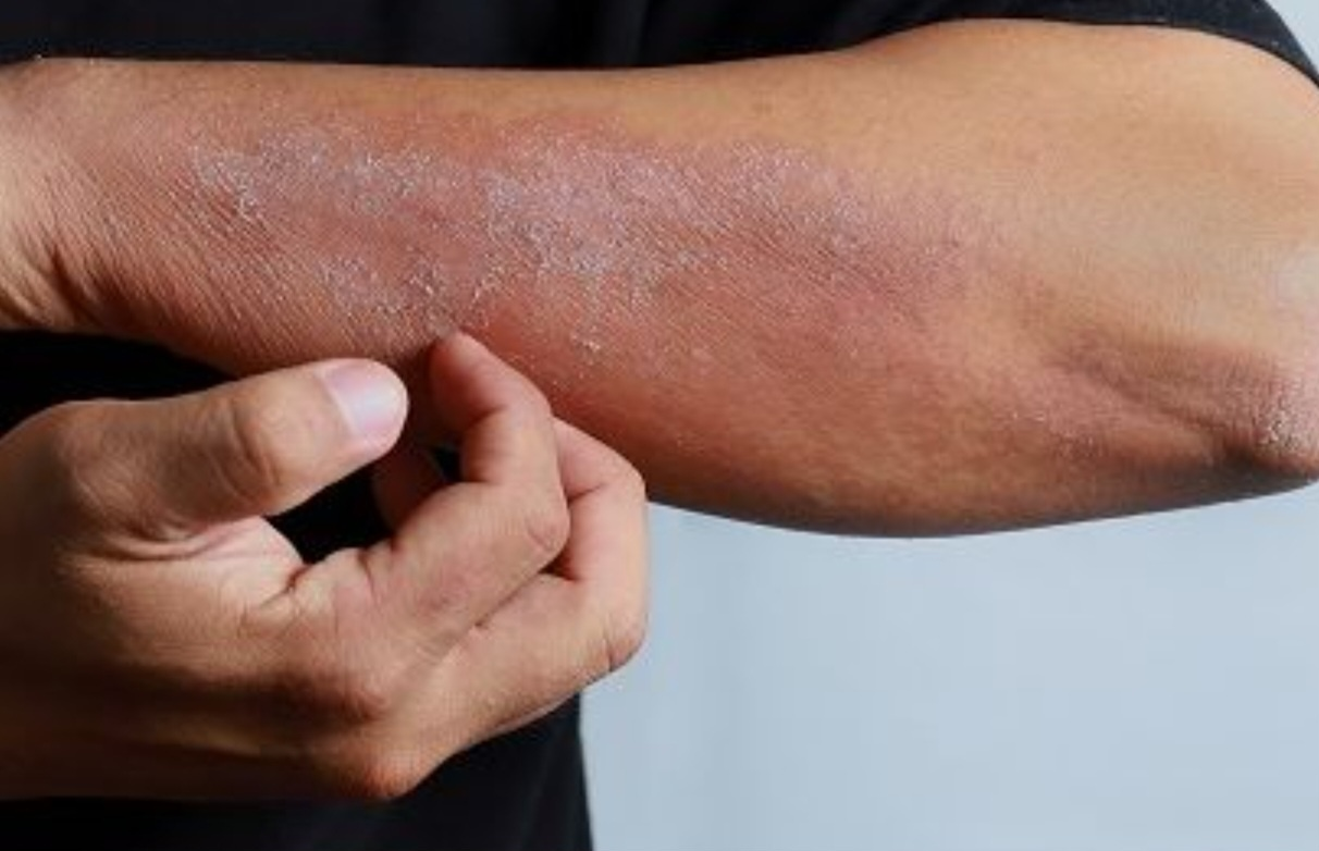 만성 두드러기 증상