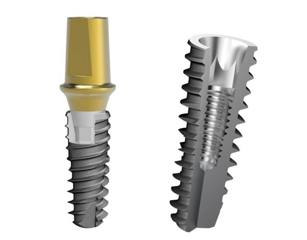 수퍼라인 임플란트