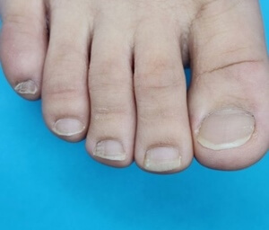 내성발톱 원인 교정기 테이프 병원 내향성 발톱 밴드 수술