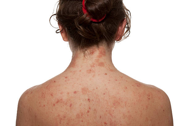 신경섬유종 증 초기 증상 1형 2형 유전 치료 약 제거 수술 병원 유전자 상염색체 종양 신경 돌연변이 밀크커피 반점 검사 예후