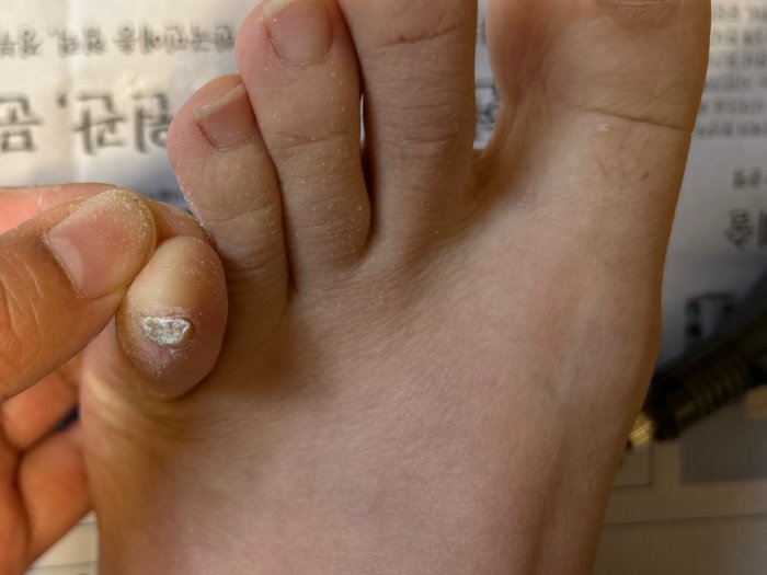 무좀발톱-단면