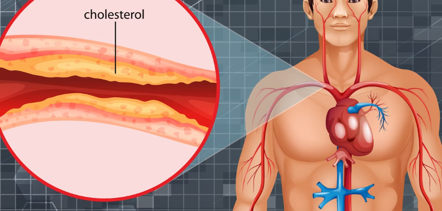 콜레스테롤의 예방법 7가지