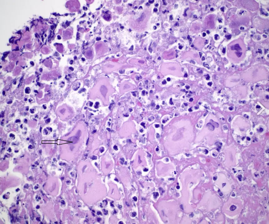 Cowdry;s type A inclusion bodies