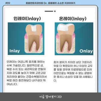 인레이 온레이의 차이와 치료 방법_10