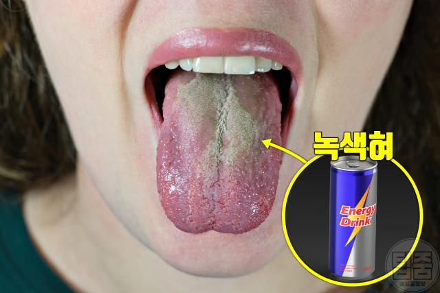 에너지드링크 부작용 카페인 혀백태 녹색