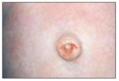 신생아 배꼽, 소독 및 관리 방법부터 튀어나옴, 육아종까지 완벽 가이드