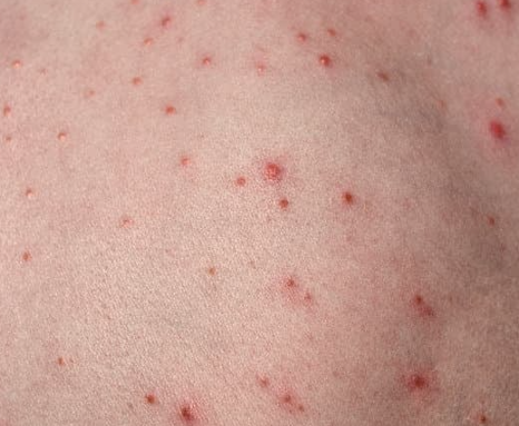 모낭염 원인과 치료방법