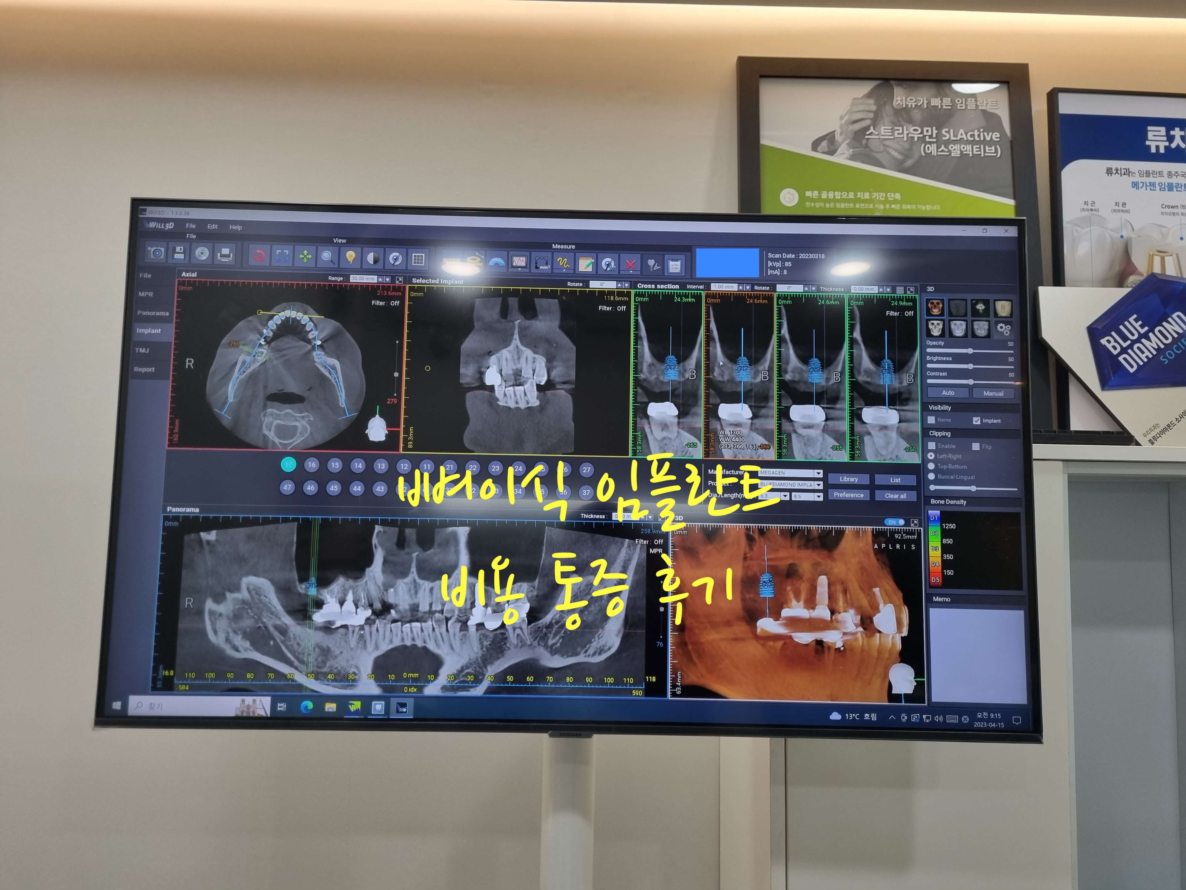 뼈이식 임플란트 비용