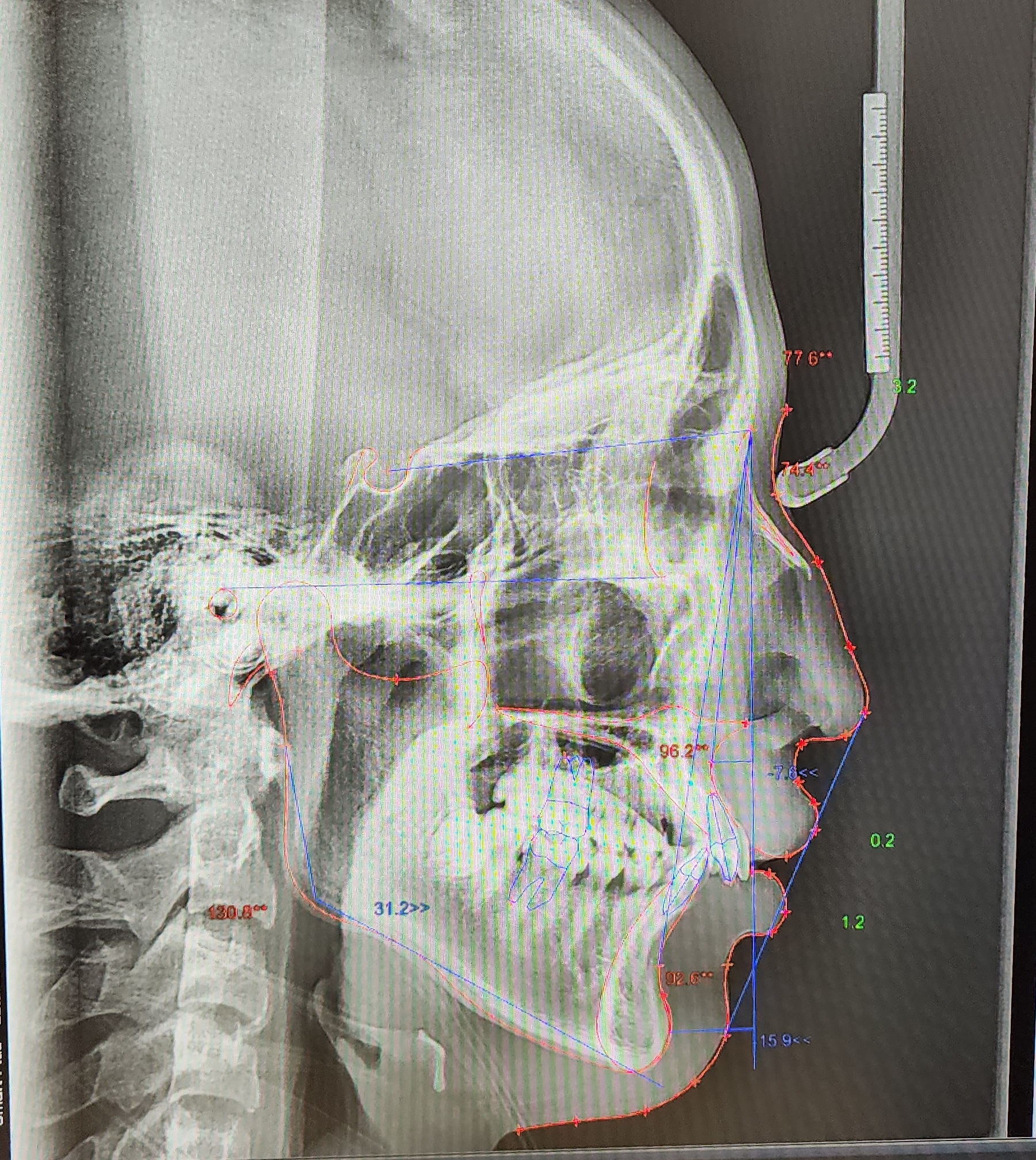 부정교합 가위교합 과개교합 치아교정 후기6