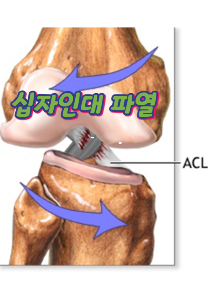 1.십자인대파열?