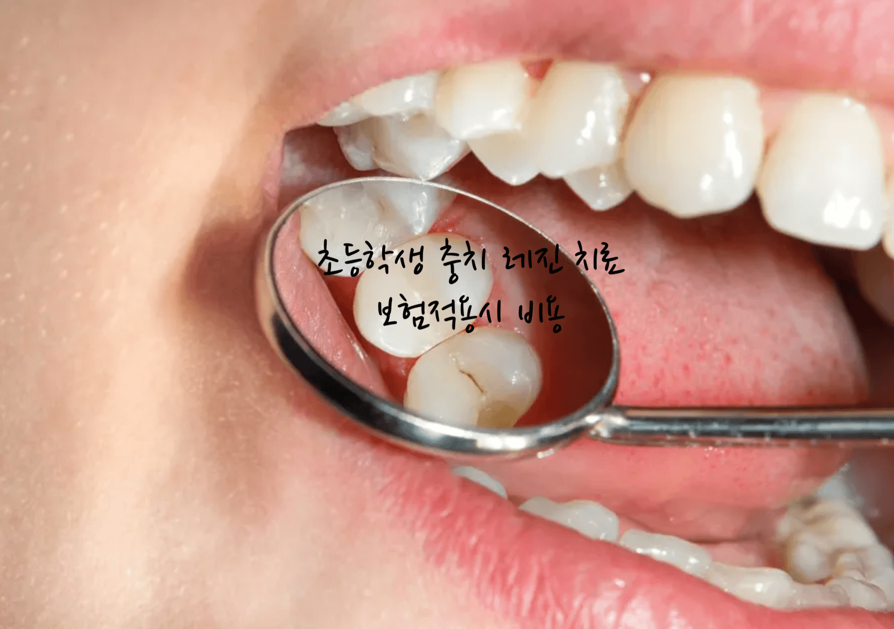 초등학생 충치
