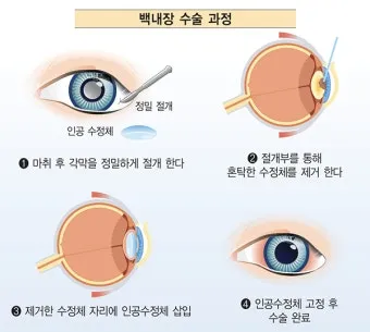 백내장 수술 비용 실비 보험 청구 회복기간_34