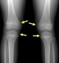 성장판 닫혀도 키크는법