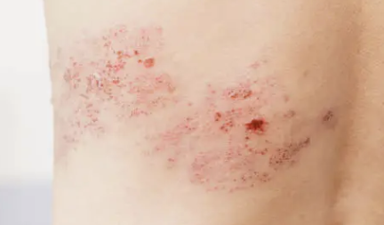 왼쪽 아랫배 통증 35