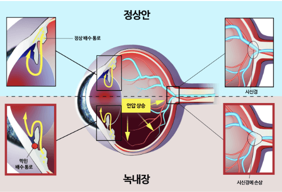 안압상승 녹내장 원인