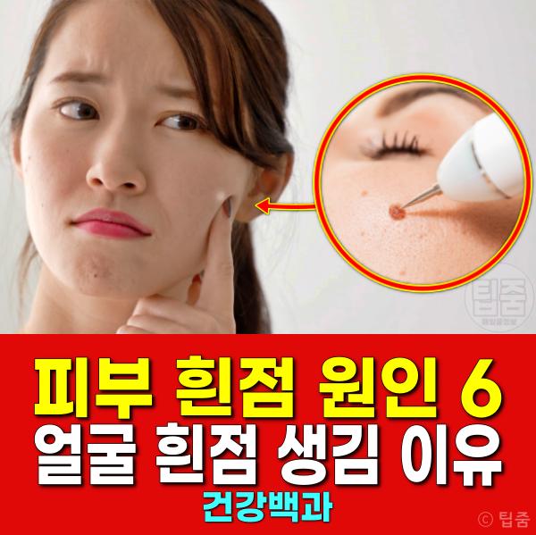 피부에 흰점 생기는 이유 얼굴흰점 원인